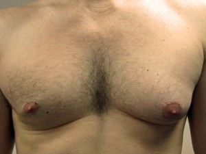 A) Enlarged left breast