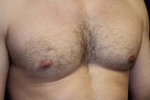 D) L. male breast reduction after surgery - oblique view