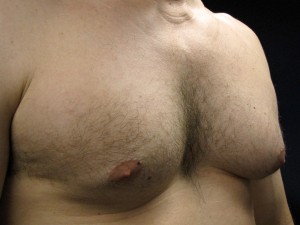 C) Left breast before surgery - oblique view