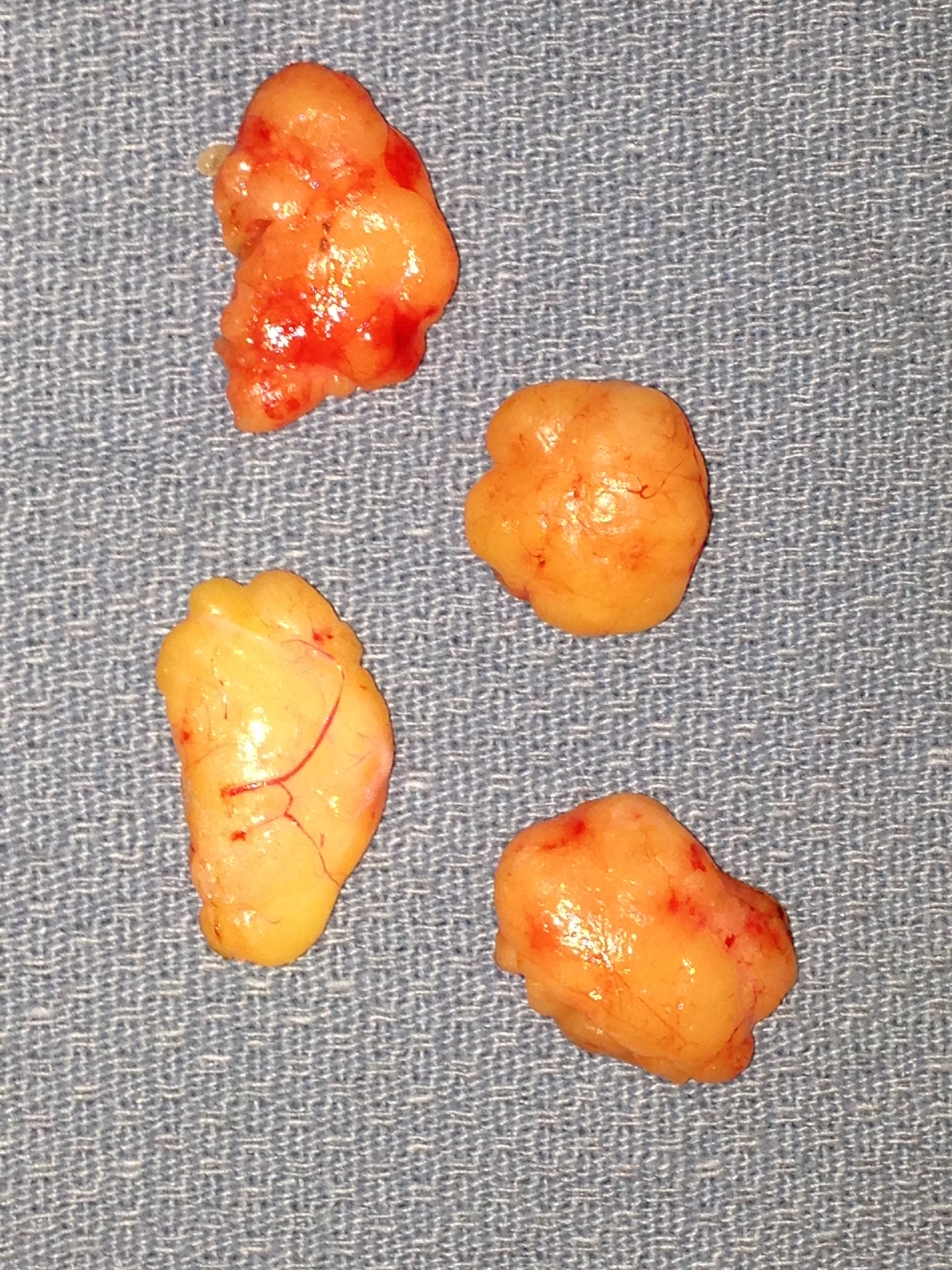 What is a Fatty Lipoma? (with pictures) - wiseGEEK