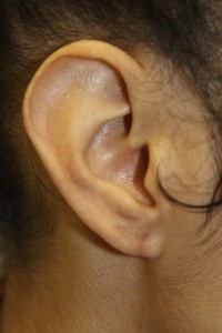 B) Right earlobe after removal of keloid