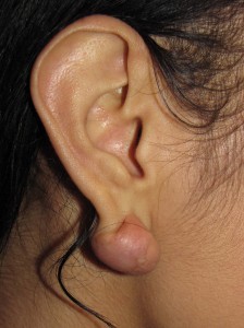 A) Dumbbell shaped keloid right earlobe