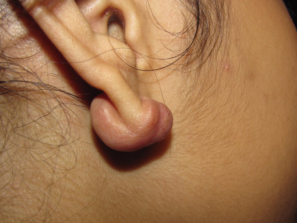 Keloid right earlobe obl