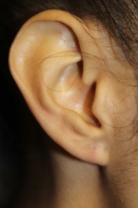 C) Right ear almost one year after surgery