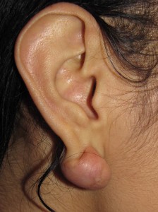 B) Horseshoe keloid of right earlobe before surgery