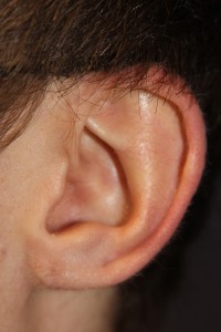 B) Left earlobe after surgery