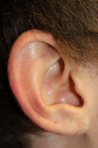 D) Earlobe after surgery