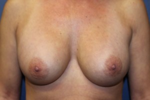 B) 13 years after breast augmentation