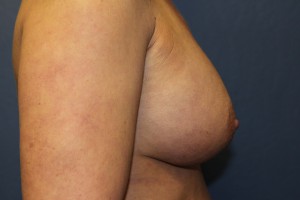 D) 13 years after breast augmentation - side view