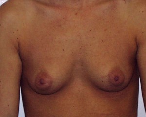 A) Before breast augmentation