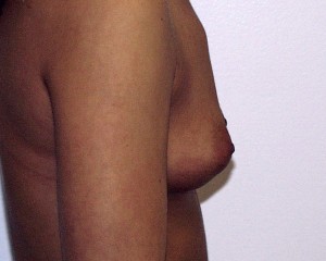 C) Before breast augmentation - side view