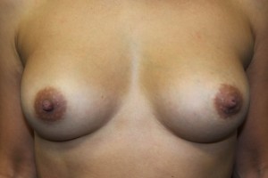 B. After breast augmentation - frontal view