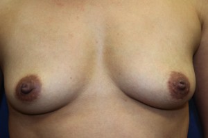 A. Before breast augmentation - frontal view