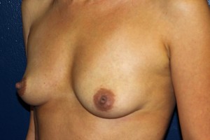 E. Before breast augmentation - oblique view