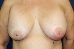 A) Before breast implant removal - frontal view