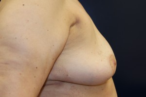 D) After breast implant removal - side view