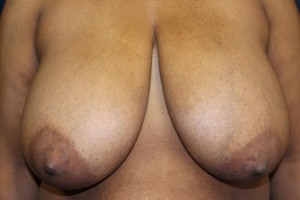 A) Before breast reduction