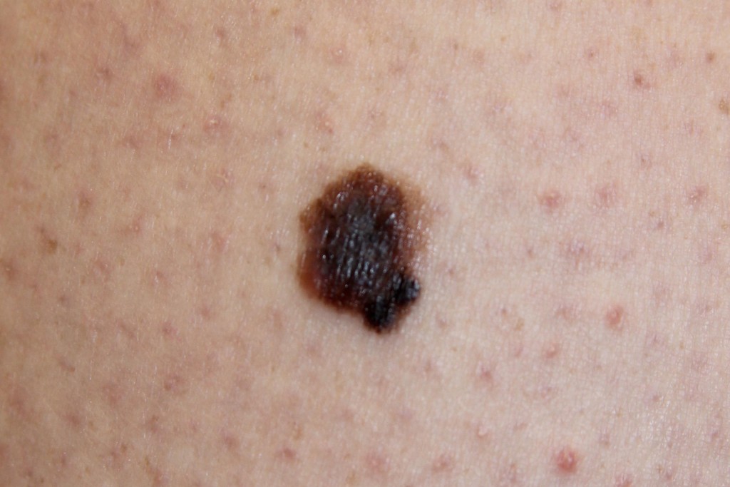 Malignant melanoma