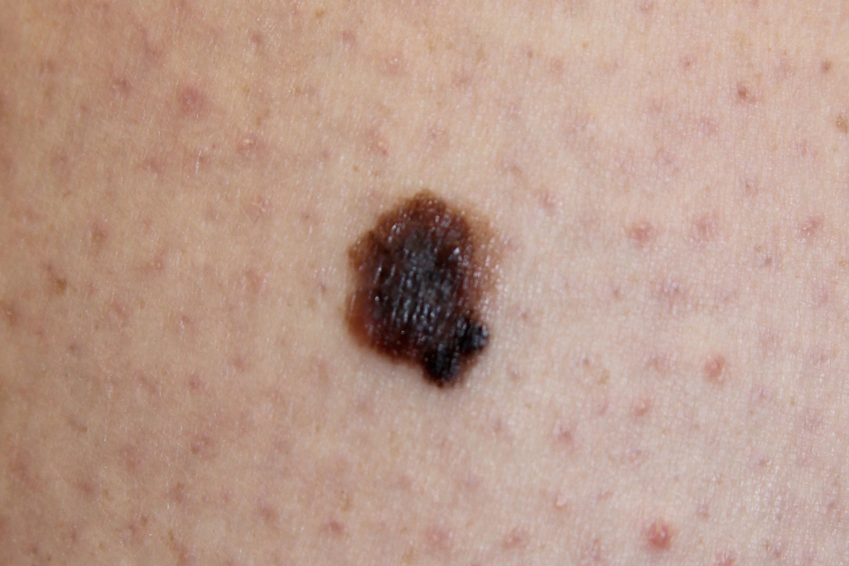 malignant skin cancer