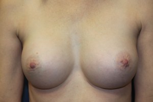 B) After surgery using different sized implants