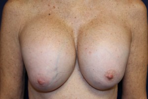 A) Deformed breasts after breast augmentation