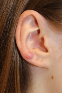 A. Keloid of the right ear