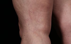 After Excel V laser treatments of leg spider veins