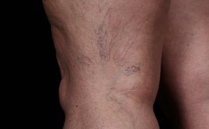 Spider veins of leg before treatment