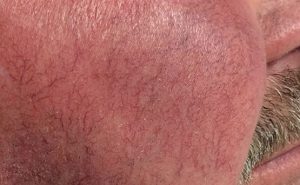 Facial redness and telangiectasia before treatment