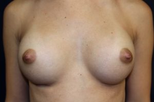 B. After breast augmentation and release of inverted nipples