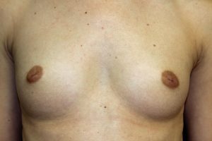 A. 28 year old woman with small breasts and inverted nipples 