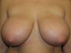 A.) Before breast reduction surgery