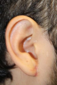 D. Gauged right earlobe after repair