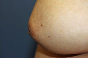 Aesthetic and predictable correction of the inverted nipple