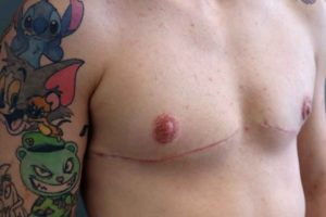 Featured image of post Top Surgery Phoenix This surgery is typically performed by a plastic surgeon that