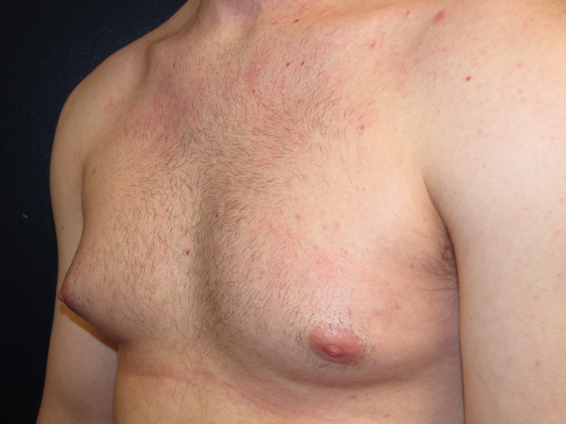 Will My Gynecomastia Resolve with Weight Loss?
