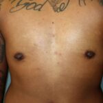JP Drains and Your FTM or FTN Top Surgery  Arizona Center for Aesthetic  Plastic Surgery