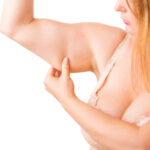 Woman With Excess Fat On Arm