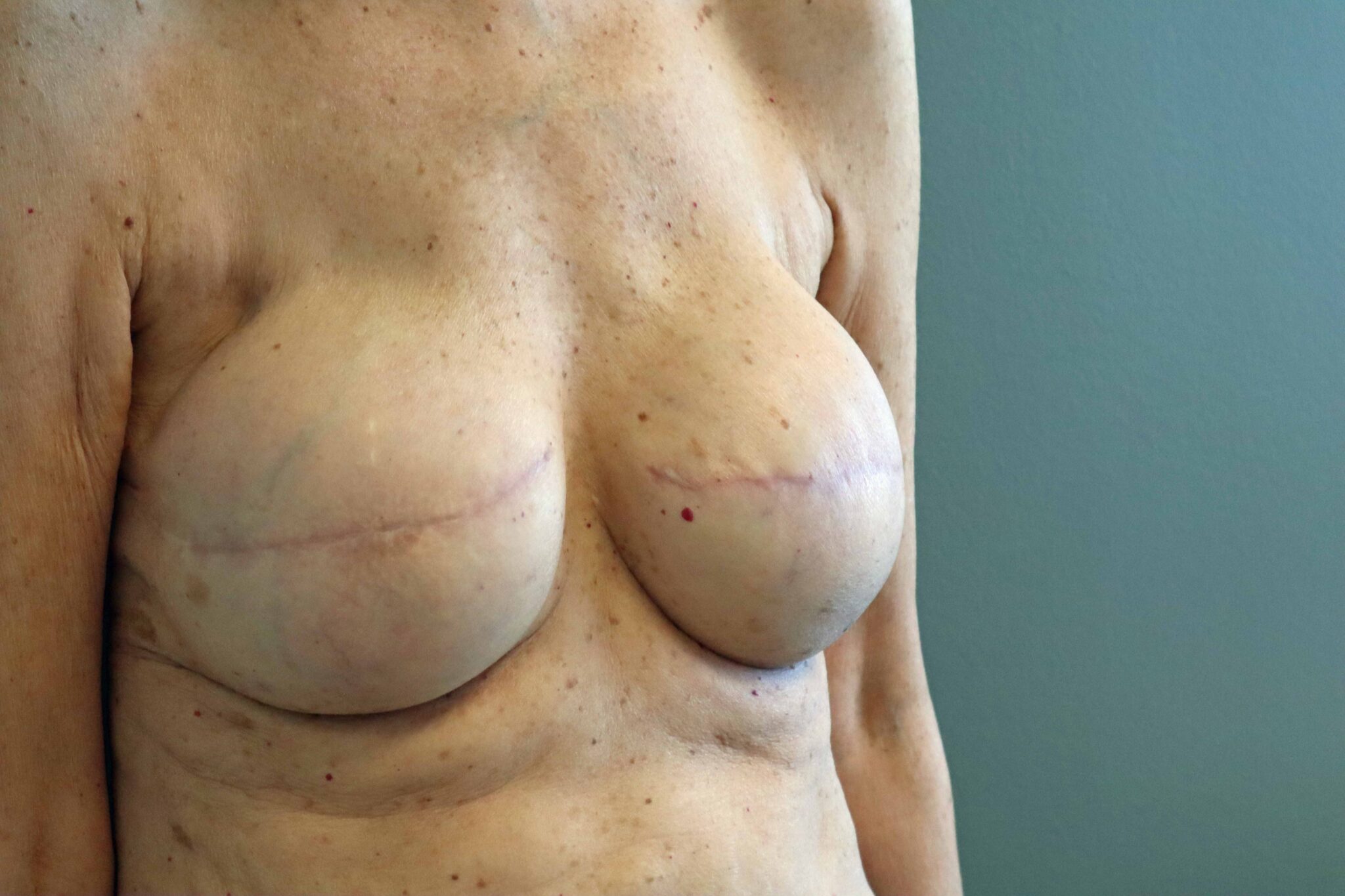 Breast Reconstruction is Rarely a One and Done Outcome.