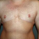 JP Drains and Your FTM or FTN Top Surgery  Arizona Center for Aesthetic  Plastic Surgery