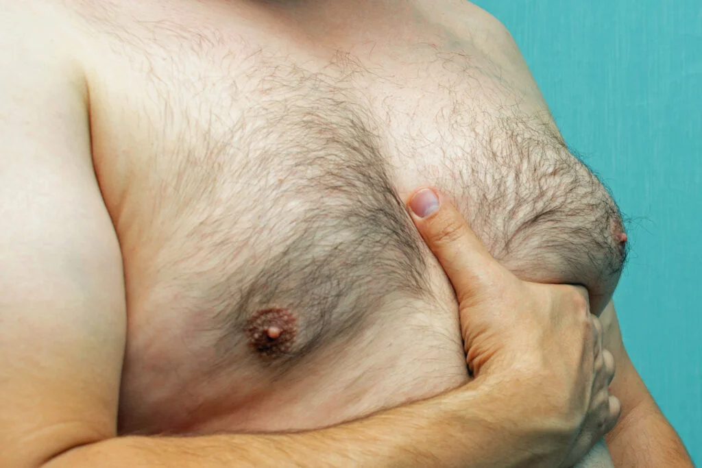 gynecomastia,droopy male breasts,skin removal,lift - New Gynecomastia