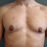 FTM Top Surgery Magic: A Muscular Masculine Chest