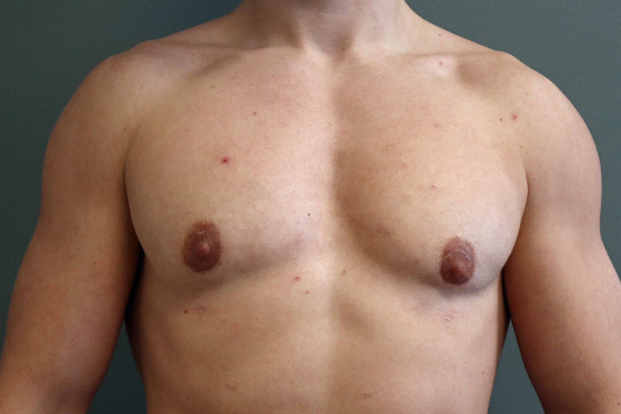 Srugery Magic FTM Top Surgery Magic: A Muscular Masculine Chest | Arizona Center for ...