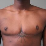 Blog Post: FTM Top Surgery and the Athletic Chest: What's Possible with Dedication and Hard Work