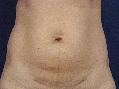 Best Tummy Tuck in Phoenix  Abdominoplasty Surgery Scottsdale